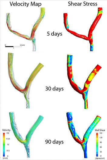 AVF Hemodynamics Characterizing anatomy and flow after AVF creation with MRA V-HEALTH Study Extra-vascular allogeneic endothelial cells to improve AVF or AVG