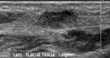 alteration to the collagen profile of the plantar