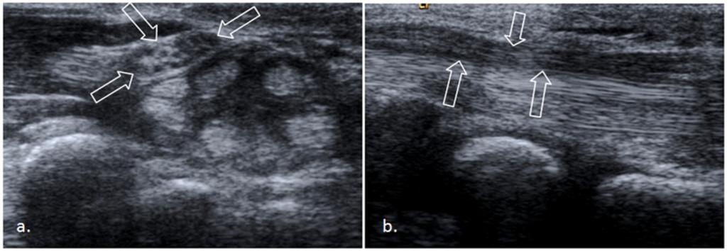 Fig. 8: Unilateral hand hypoplasia.