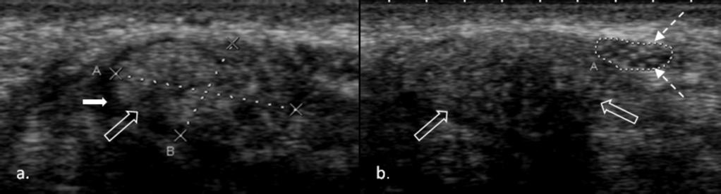 Transverse (a) and longitudinal (b) US scans of a 7 year-old girl with unilateral symptoms of CTS,