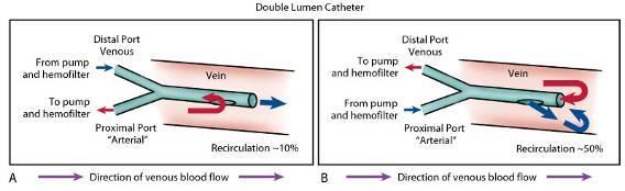 Hemodialysis Catheter Large lumens accommodate hemodialysis or plasmapheresis procedure (harvests specific blood cells) Catheter-related