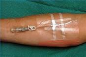 Midline Catheter 3 to 8 inches long, 3 to 5 Fr, double or single lumen Inserted through vein in upper arm
