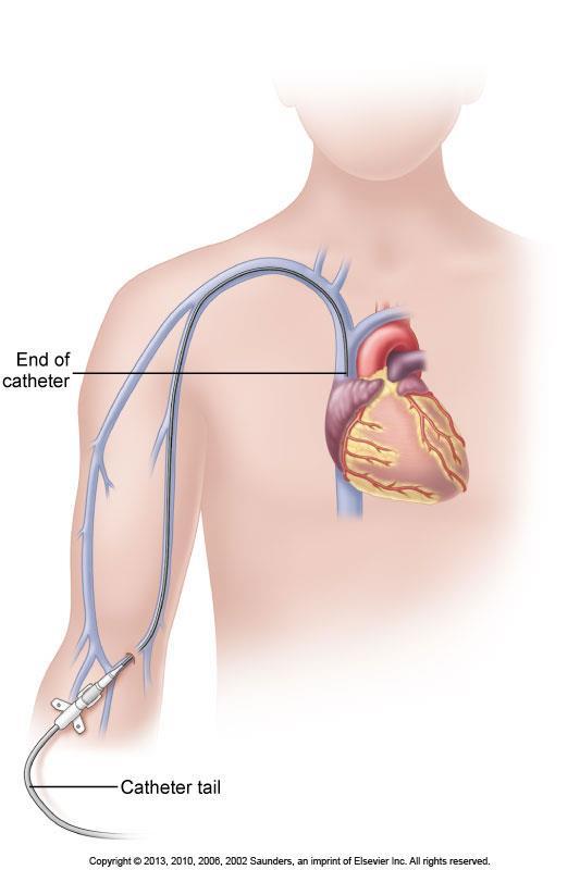 Peripherally Inserted Central Catheter (PICC) Length of 18 to 29 inches (45 to 72 cm) Chest x-ray