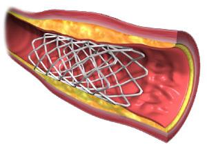 Stent thrombosis (ST)- an abrupt thrombotic occlusion Usually within first 30 days after bare metal stent (BMS) DAPT (aspirin plus platelet P2Y 12 receptor blocker) significantly lowers the risk of