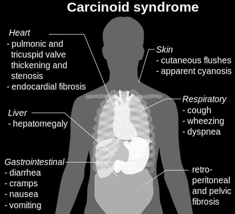 NEUROENDOCRINE TUMOURS: CARCINOID SYNDROME Some NETs (more commonly NETs of small bowel, large bowel or appendix) may overproduce serotonin Serotonin causes