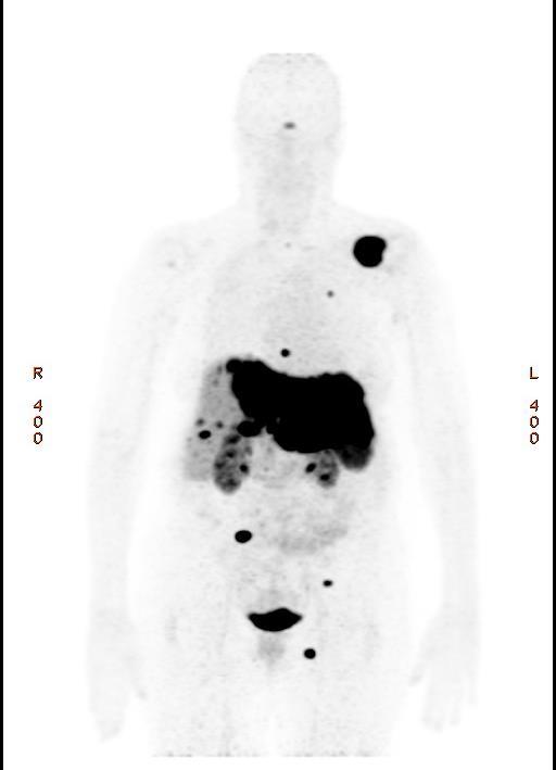 68 GALLIUM DOTANOC PET CT SCAN Segment 1, 2, 3 and 4 of liver largely replaced and expanded by tumour Infiltration of adjacent segments 5 and 8 with multiple smaller discrete tracer avid lesions in
