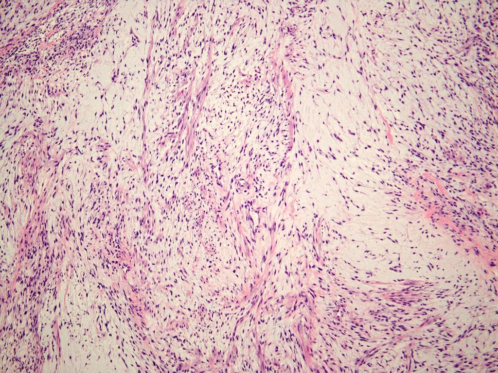 Mimic myxoid leiomyosarcoma
