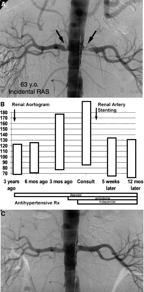 1370 Circulation August 30, 2005 Figure 5. A, B, Angiograms and blood pressures in a 63-yearold man with incidentally identified renal artery stenosis during coronary angiography.