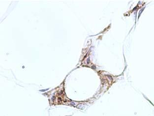 In obese mice, adipose tissue macrophages have an unusual morphology: lipid vacuoles, multinucleated.