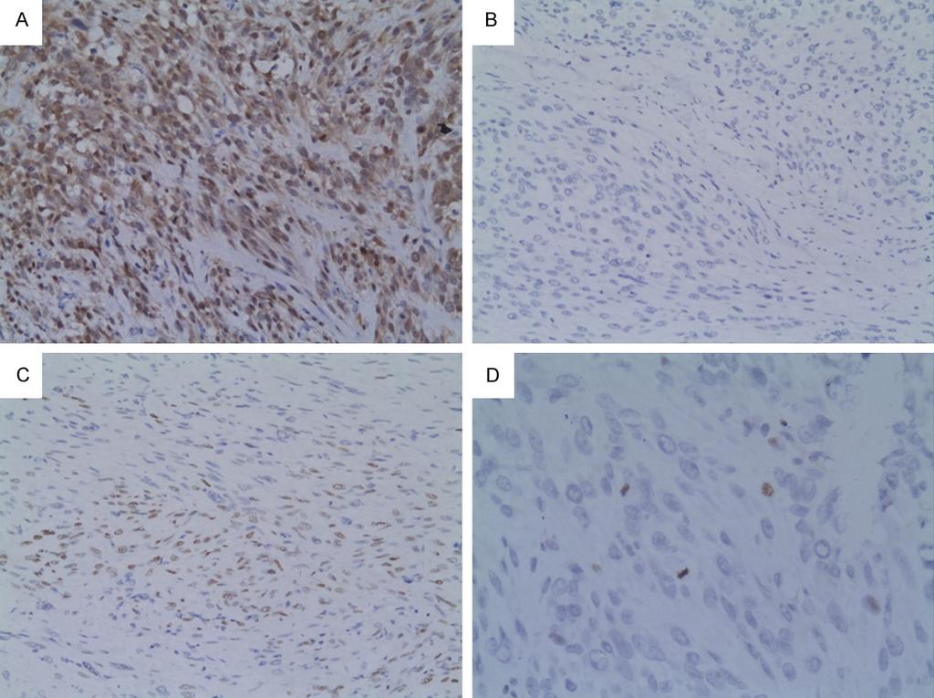 Figure 2. Immunostaining in leiomyosarcoma. A. High nuclear and cytopalsmic staining in p16 ( 200). B. Scattered nuclear positivity in PR ( 200). C. Low nuclear positivity in p53. D.
