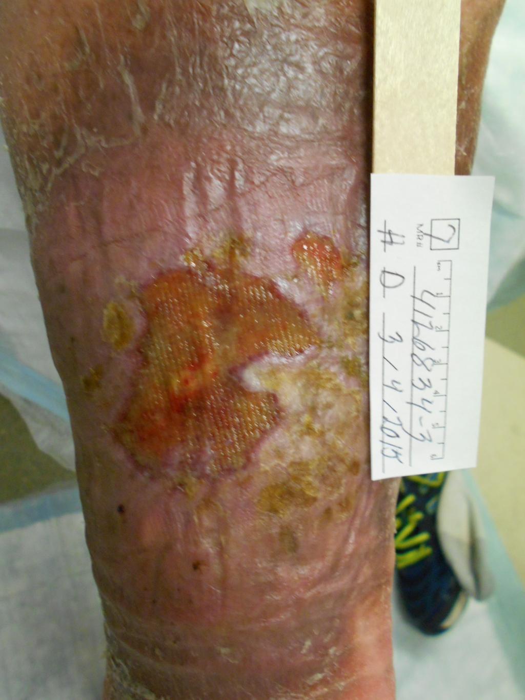Chronic nonhealing leg ulcer 52 YO male w h/o multiple DVTs starting 11 yrs before initial visit in