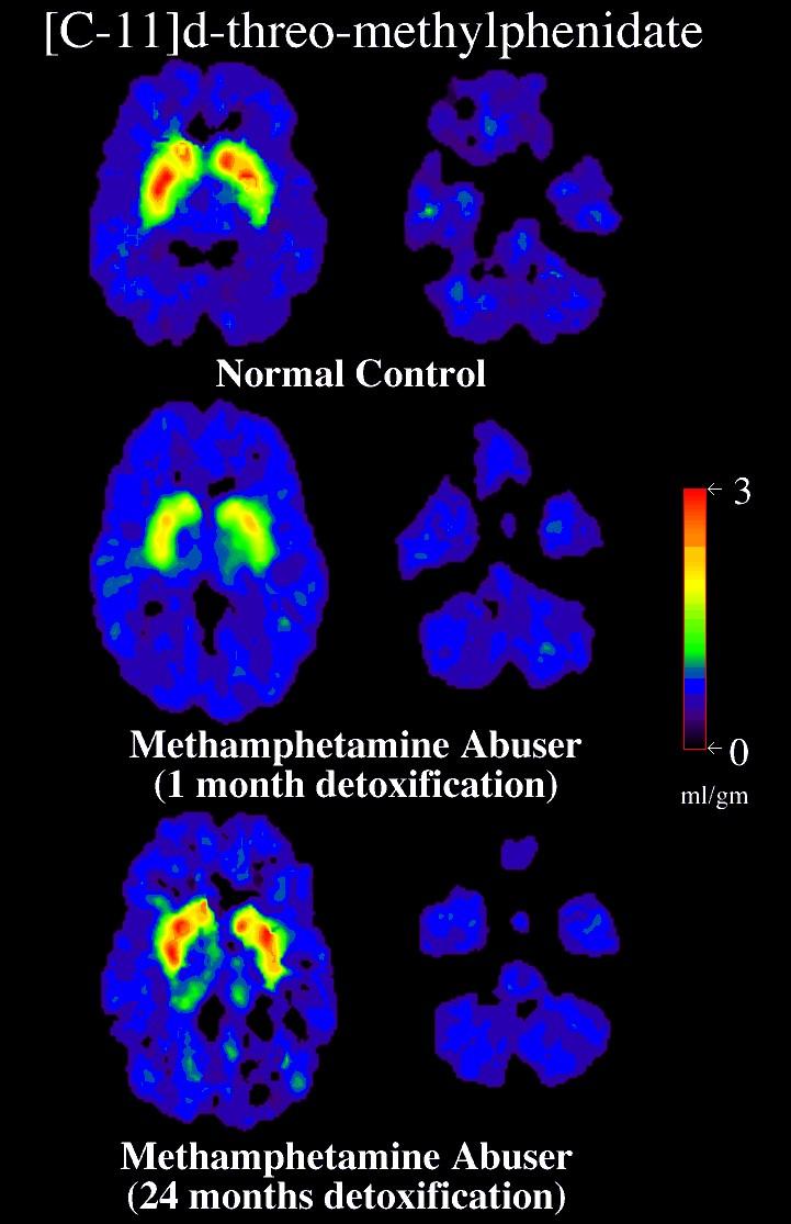 [C-11]d-threo-methylphenidate 14 months + to recover from Methamphetamine!