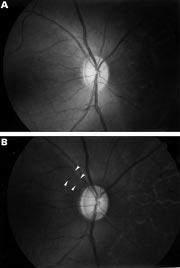 1292 Jonas, Hayreh All eyes showed no abnormality on a detailed ophthalmic evaluation before the production of elevated intraocular pressure.