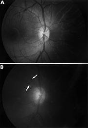 Localised retinal nerve fibre layer defects in chronic experimental high pressure glaucoma in rhesus monkeys 1293 Figure 2 Fundus photographs of monkey before (A) and after (B) experimental elevation