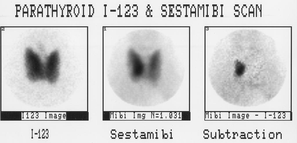 Sestamibi Parathyroid Scan Dual photon,