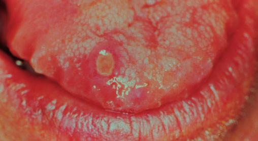 66 Diagnosis and Management of Oral and Salivary Gland Diseases eye lesions. The concept of the disease has changed from a triad of signs and symptoms to a multisystem disorder.