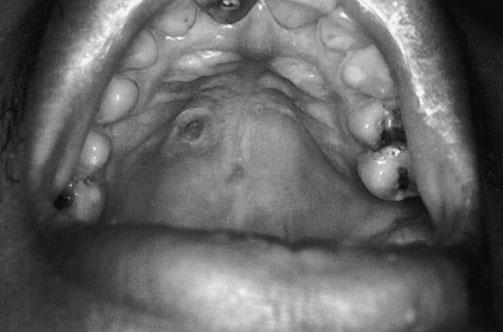 78 Diagnosis and Management of Oral and Salivary Gland Diseases infection commonly follows a chronic course beginning with mild symptoms such as malaise, low-grade fever, and mild cough.