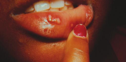 Ulcerative, Vesicular, and Bullous Lesions 53 FIGURE 4-2 A 12-year-old female with primary herpetic gingivostomatis causing discrete vesicles and ulcers surrounded by inflammation.