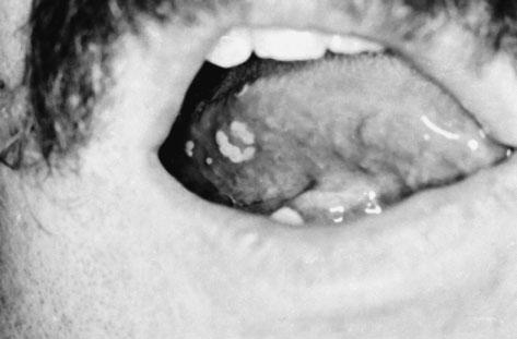Ulcerative, Vesicular, and Bullous Lesions 55 FIGURE 4-6 A cluster of vesicles on the tongue in a patient with herpangina.