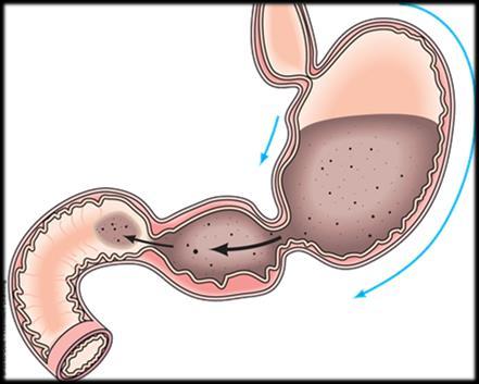 duodenum prevent gastric emptying Leaving the stomach.