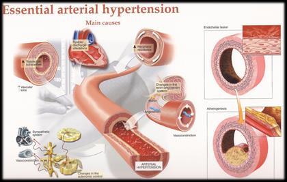 Hypertension can be due to increased renin leading to more plasma