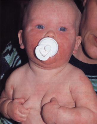 Infants Face Extensor surfaces Diaper-