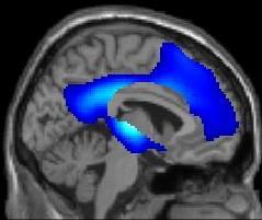 3. Long distance subcortical area