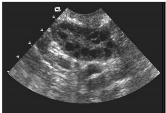 Figure(2) Transversepelvic sonogram showspcos ovaries in a 33 year-old female with oligomenorrhea and infertility. II.