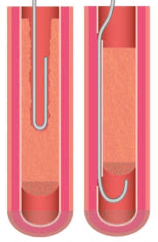 J-loop technique Knuckle wire intraluminal (lambda) Subintimal