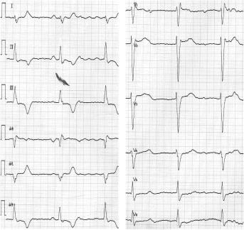 J Arrhythmia Vol 25 No 4 2009 a) b) Figure 2 a) The 12-lead electrocardiogram on admission showed a wide QRS rhythm of 48 beats/min without any pacing spikes despite the programmed ventricular