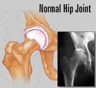 In hip arthritis patients may have significant pain and treatment is necessary The Hip Joint-Basic Anatomy The hip joint is a simple ball and socket joint.
