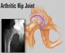 of cartilage Hip Joint Degredation Osteoarthritis in the hip joint is the wearing of the articular cartilage on the surfaces of the bones that form the hip joint.
