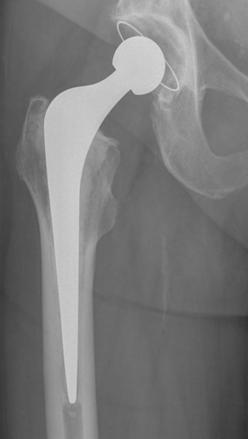 The end of the femur is resected and the canal of the femoral bone is prepare to accept the femoral stem component of the hip implant.