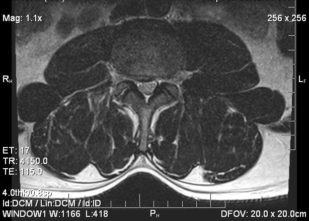 a referral to the Spine Center of Hampton Roads for co-management. Lumbar Spine MRI dated September 30, 2009 Mild circumferential disk bulge.