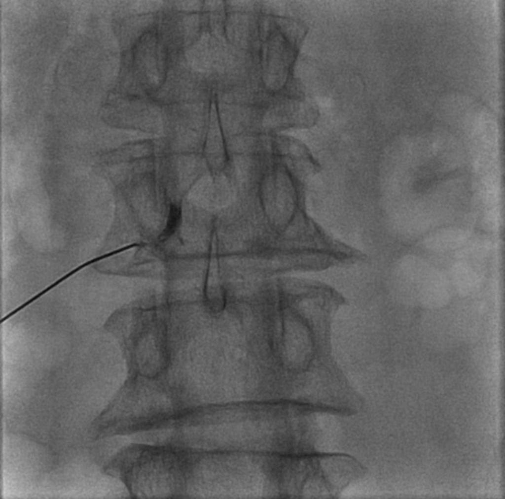 Fig. 6: Selective right L3 nerve root block after