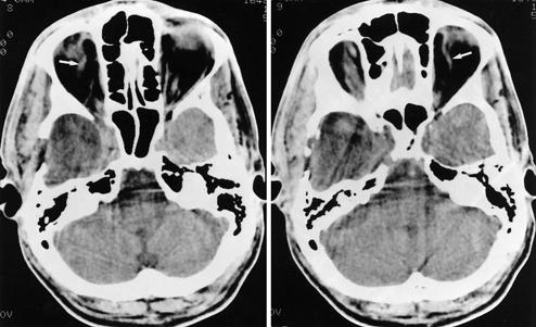 R. K. Khanna, et al. FIG. 3. Follow-up CT scans in the same patient. Left: The right superior ophthalmic vein (arrow) has returned to its normal size. Note the right temporal lobectomy.