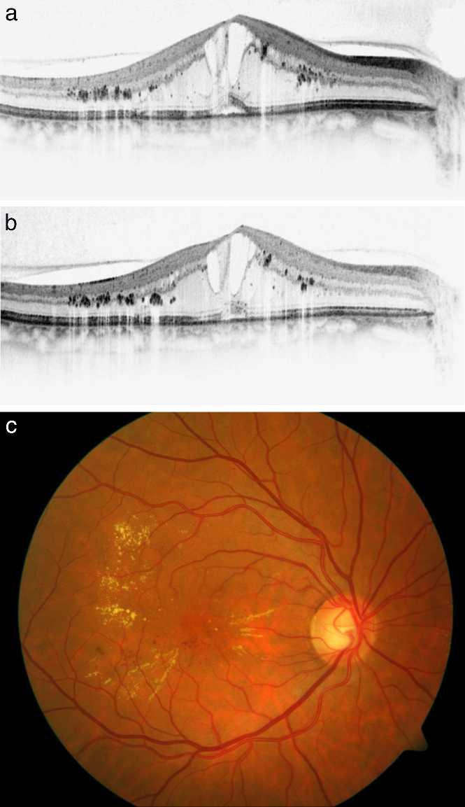 IOVS, August 2012, Vol. 53, No. 9 Anti-VEGF Effects on Retinal Hyperreflective Foci in DME 5817 FIGURE 5. Right eye of a 55-year-old male patient.