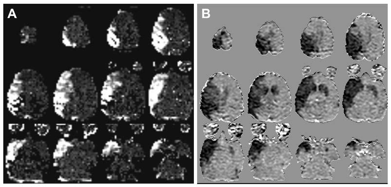 Peri-infarct spreading depression after MCAo in M. fasicularis The Open Neuroimaging Journal, 2011, Volume 5 155 Fig. (1).