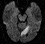 Pt D: Imaging ischemic strokes with MRI Diffusion-Weighted Imaging