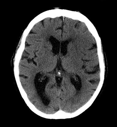 Patient A: Non-contrast CT Findings *** No evidence of hemorrhage*** Loss of gray-white matter distinction
