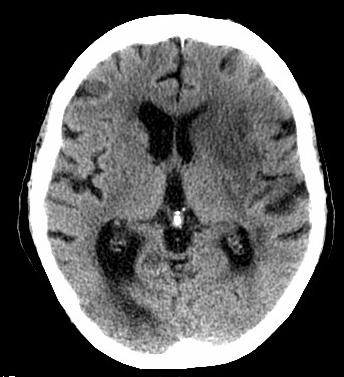 Patient A: Progression of Infarct Findings No evidence of hemorrhagic transformation