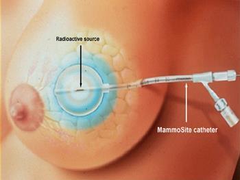 Post lumpectomy, the catheter is placed in the breast cavity either during the lumpectomy procedure or later