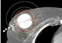 depending on the size of the lumpectomy cavity CT imaging to assess the adequate placement of the device An