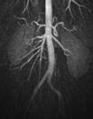 ANGIOGRAPHY Rotational views show  measurements Not Ideal