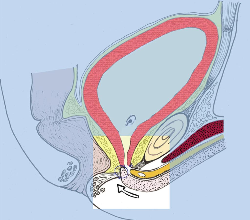 During a flexible urethroscopy a guide-wire is passed into the bladder.
