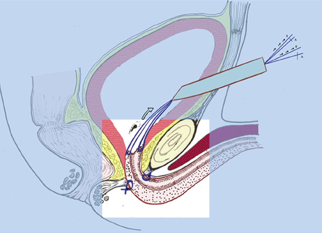 4 Advances in Urology (a) (b) Figure 2: (a) Placing of 2 0-0 sutures at the proximal edge of the anterior urethra. They pass into the Nelaton supra-pubical catheter.