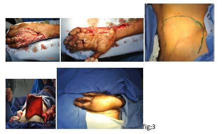 Figure 3: Details Given as Case 1 Crush Injury LT Hand Case 2: H/o crush injury to LT hand.