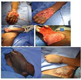 Case 3: 45 year male patient. Post burn contracture of RT hand.