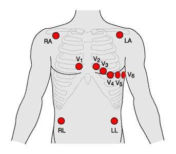 12 Lead EKG A 12-lead ECG consists of three bipolar limb leads (I, II, and III), the unipolar