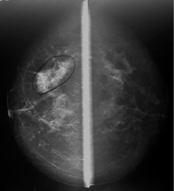 (ASTRO) considered 2 mm as standard margin that should be complemented by whole-breast irradiation.